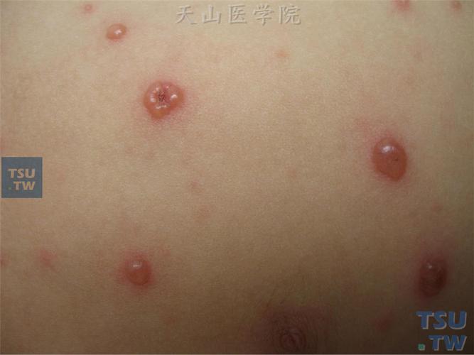 水痘初期症状图片