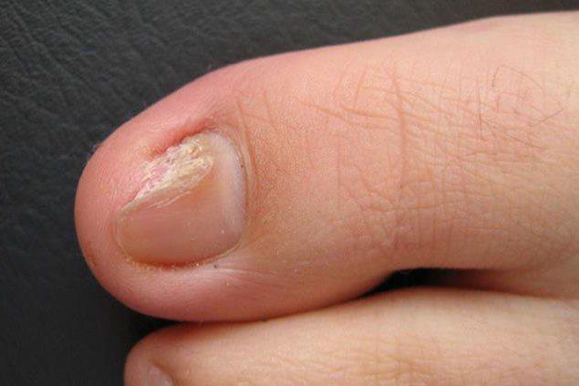 灰指甲早期症状图