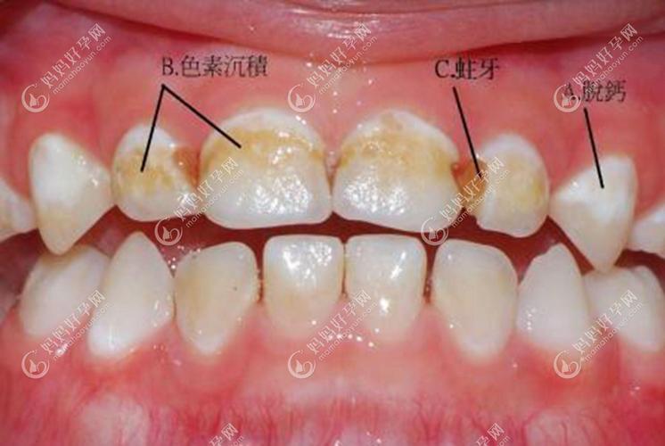 牙齿钙化图片