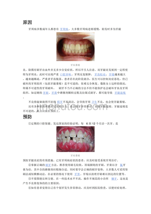 牙龈萎缩的原因的相关图片